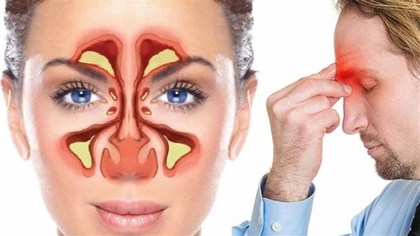 أقوى المشروبات العشبية لتسكين آلام الصداع المزمن