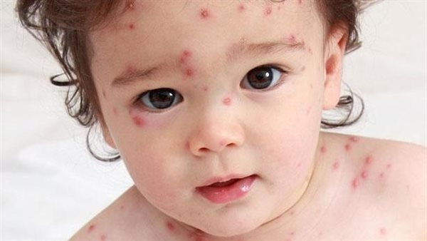 اعرفي الفرق بين حساسية الصيف والجديري المائي