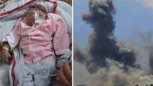 نتيجة صواريخ إسرائيلية جديدة، ولادة طفلة "بلا دماغ" في غزة