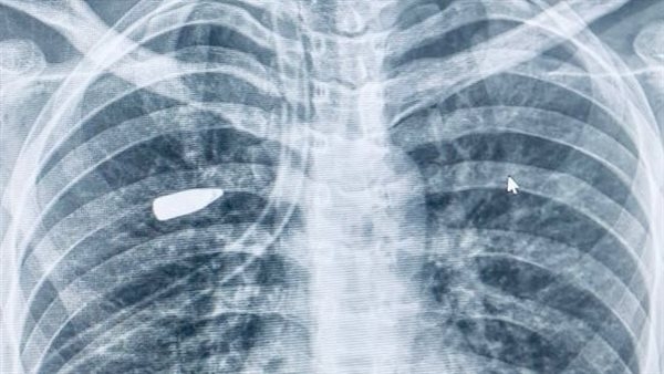 فريق طبي بجامعة أسيوط ينجح في استخراج مقذوف ناري من رئة فتاة بالمنظار