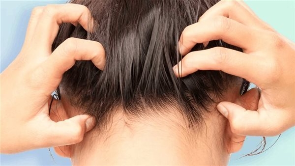 وصفة طبيعية لعلاج قشور والتهابات فروة الرأس
