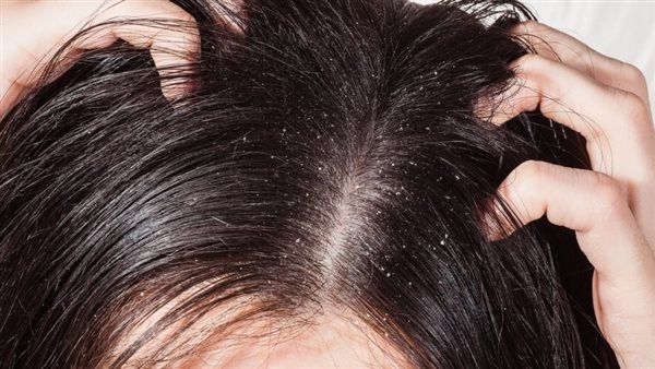 وصفة الحلبة والزبادى تخلصك من قشرة الشعر
