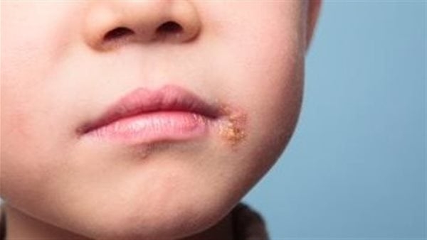 أعراض الهربس الفموي عند الأطفال وأسبابه ومخاطره