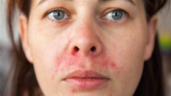 قناع طبيعي يساعد في علاج التهابات البشرة