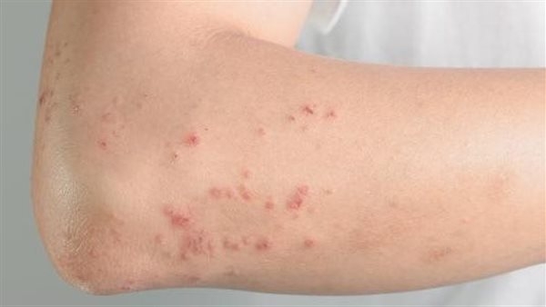 ما هي حساسية الدم وأعراضها وطرق علاجها في الحالات الطارئة؟