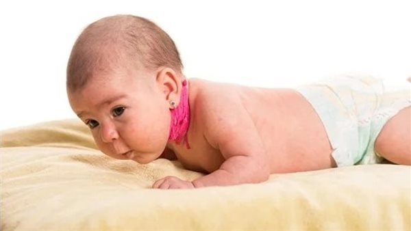 أسباب الصعر العضلي الخلقي عند الأطفال