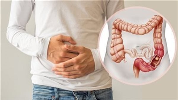 أعراض القولون العصبى وأسباب الإصابة به وأفضل طرق للعلاج