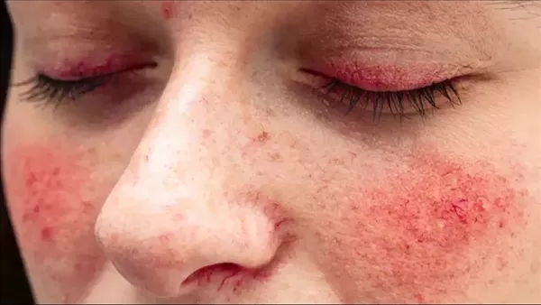 أعراض الذئبة الحمراء وأسبابها وطرق علاجها