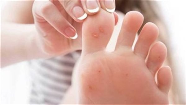 أسباب عين السمكة وأعراضها وطرق التخلص منها