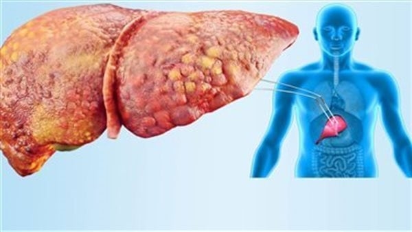 أعراض دهون الكبد وأسبابها ومخاطرها الإصابة بها