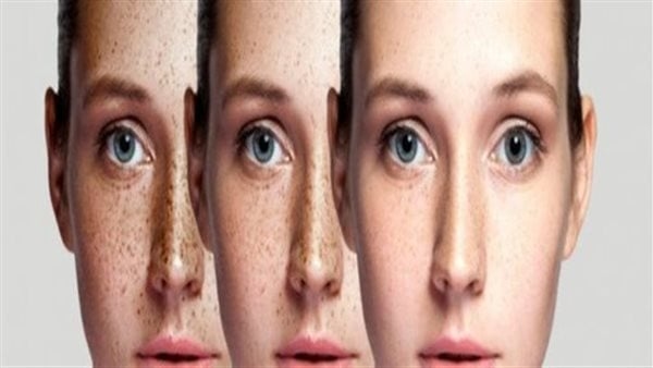 7 وصفات طبيعية للتخلص من النمش في وقت قياسي