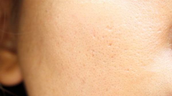 قناع طبيعي يخلصك من البثور البيضاء بالبشرة