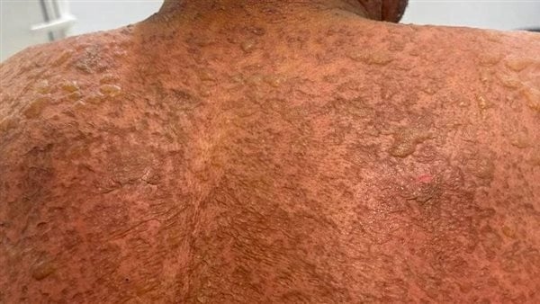 إنقاذ مريض ستيني مصاب بمتلازمة ستيفنز جونسون في مستشفى المنصورة الدولى بالدقهلية