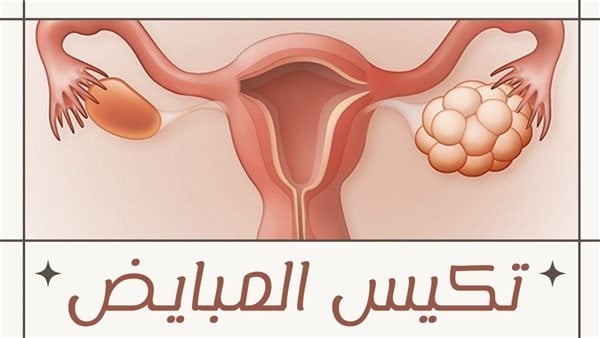 تكيسات المبايض بين العلاجات الطبية والطرق الطبيعية