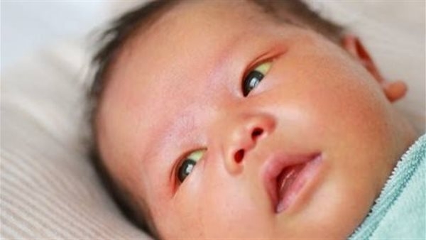 أعراض وطرق علاج الصفراء عند الأطفال