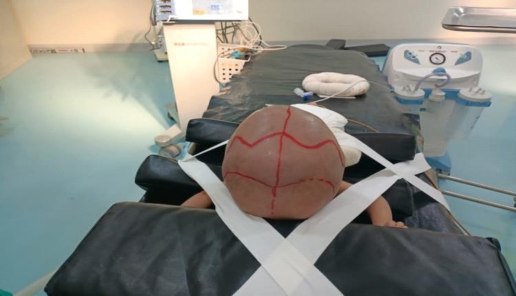 معجزة طبية في مأرب: فريق جراحي يُنقذ رضيعاً من تشوّه وتضخم دماغي خطير