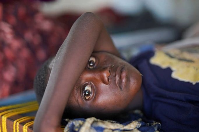 تقارير امميه: نحو 100 ألف إصابة بالكوليرا خلال عام في السودان