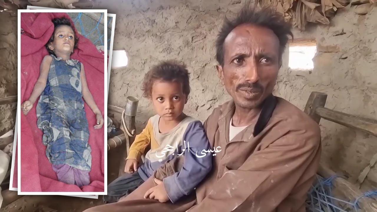 الجوع يُطفئ عيني الطفلة 'أشواق' ومسنة في مديرية عبس بمحافظة حجة