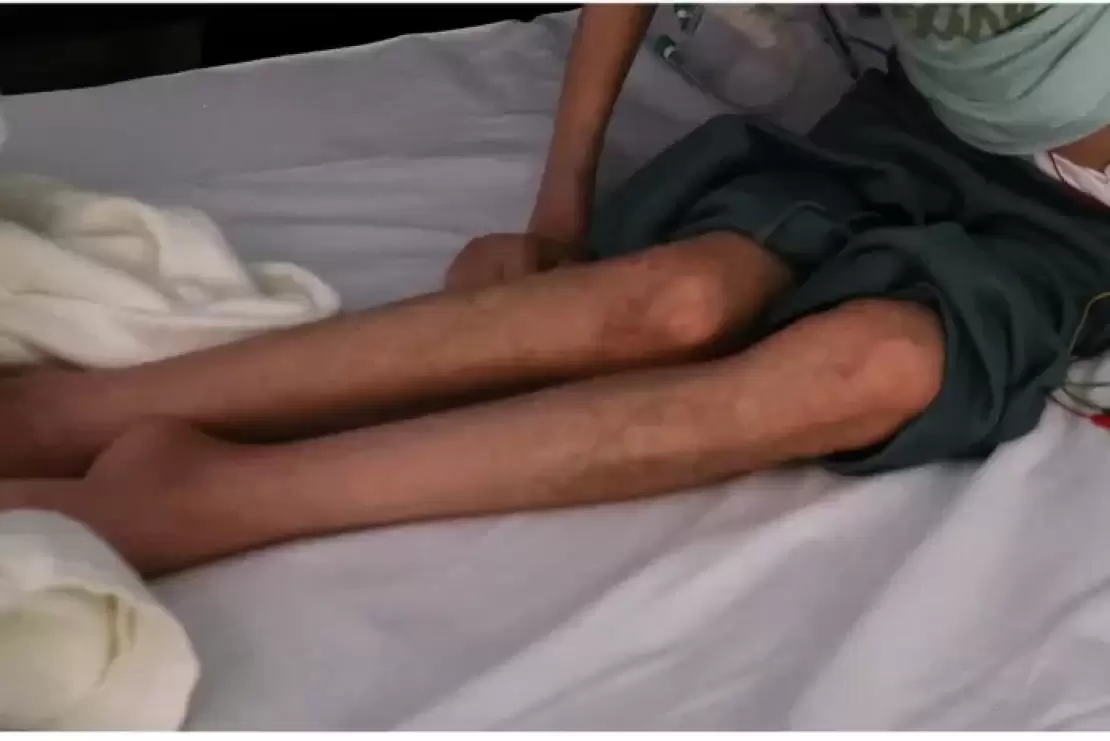 غزة.. 5 وفيات بسبب المجاعة ووباء فيروسي يفتك بـ 3 آخرين