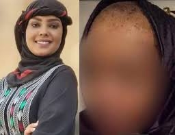 مصادر طبية تتهم مليشيا الحوثي بتسميم الفنانة انتصار الحمادي بمواد سامة ومسرطنة