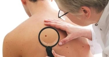 حسنة ولا بقعة ولا كدمة.. متى تكون علامات الجلد مؤشر خطر ؟