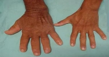 كل ما يجب أن تعرفه عن اضطراب ضخامة الأطراف
