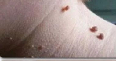 لماذا يصاب بعض مرضى السكر بالزوائد الجلدية
