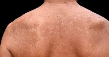 اسباب الاصابة بالتينيا وطرق الوقاية منها