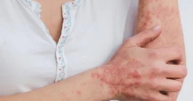 الصدفية قد تجعلك عرضة للعدوى الجلدية.. وهذه أسرار الوقاية